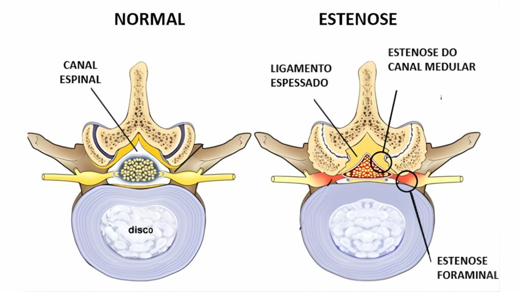Estenose do Canal Lombar: Causas, Sintomas e Tratamentos